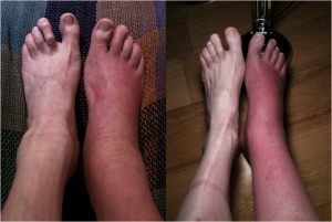 2 photo's of feet. In each image the right foot is a lot more red and swollen than the other. 